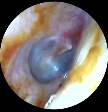 Clear ear canal and ear drum after microsuction