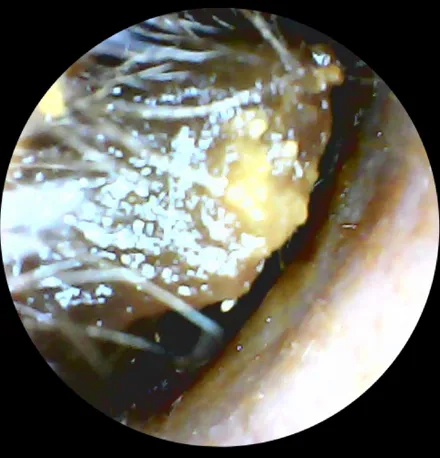 Ear canal blocked with wax before treatment