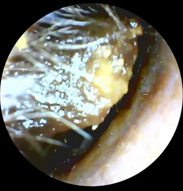 Ear canal blocked with wax before treatment